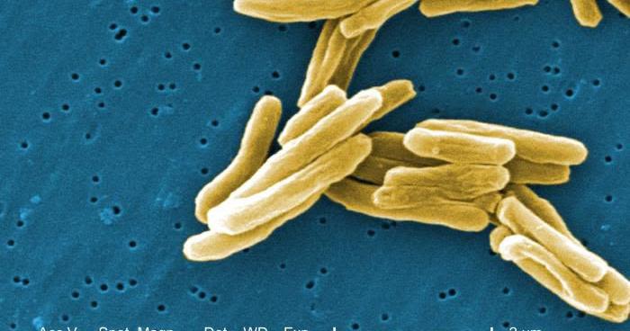 A case of tuberculosis was detected at a Chester County school. Here's what officials say.