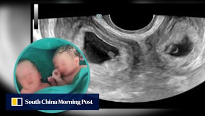 One in a million: China woman with 2 uteruses gives birth to a child from each womb