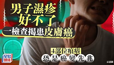 男子濕疹搽藥膏無效 一檢查揭患皮膚癌 4部位痕癢恐是癌變先兆