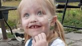 Toddler receives double-lung transplant after her skin turned blue