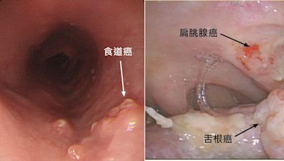 有這些習慣 罹癌風險大十倍