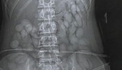 X-ray reveals 'cocaine bullets' found in stomach of woman stopped at airport