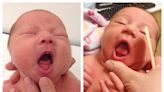 Infants' tongue-tie may be overdiagnosed and needlessly treated, American Academy of Pediatrics says