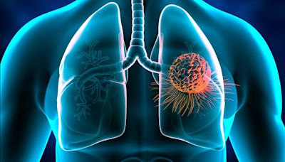 AstraZeneca’s Tagrisso gains approval in Canada for NSCLC