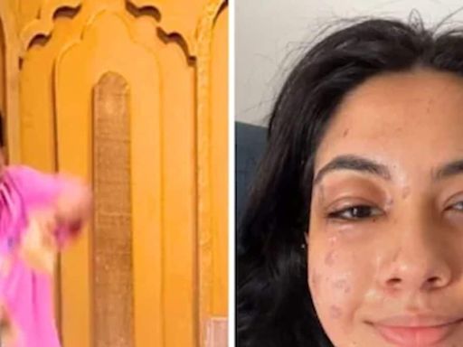 Actress Reem Shaikh Suffers Burns While Shooting For Reality Show Laughter Chefs - News18