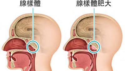 腺樣體發炎肥大可致兒童上呼吸道阻塞 港12歲發病率高 - 明報健康網