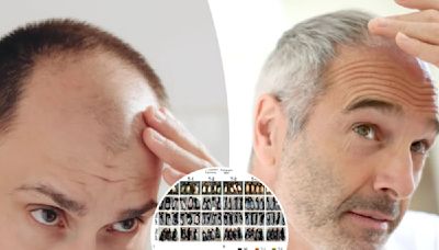 A breakthrough for baldness? Sugar gel stimulates hair regrowth