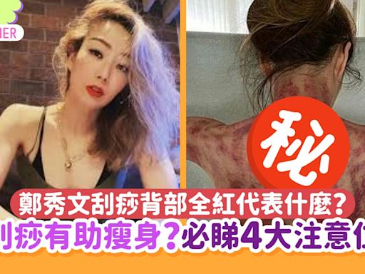 刮痧｜鄭秀文背部全紅代表什麼？有助瘦身？即睇4大刮沙冷知識