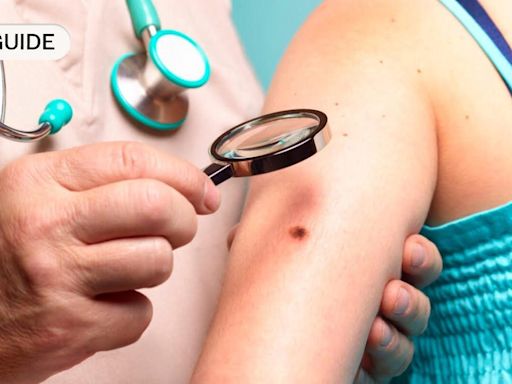 Your expert guide to melanomas and how to spot them