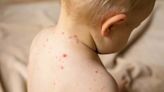 Map shows suspected measles cases on Teesside as England faces biggest outbreak in over a decade