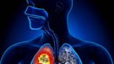 樹立標靶治療新基準 輝瑞肺癌新藥Lorlatinib臨床報佳音 - 自由健康網