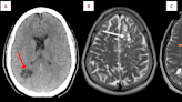 US man gets parasitic worm in brain likely from eating undercooked bacon