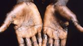 NYC investigating possible case of monkeypox as global infections rise