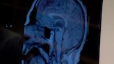 Deep brain stimulation could offer treatment for depression