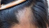 FDA approves 1st treatment that can grow back hair for teens with severe alopecia areata