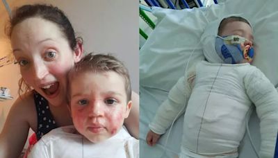 Mum's 'worst nightmare' as toddler's skin 'peels off' after pouring boiling tea over himself