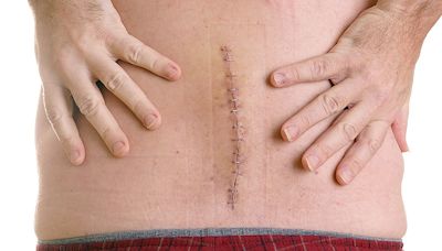 Diabetes/Weight Loss Med Linked to Repeat Spinal Surgery