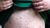 Introducing routine chickenpox jabs for children ‘could end risky pox parties’