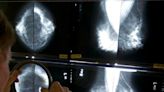 In reversal, expert panel recommends breast cancer screening at 40 - The Boston Globe
