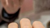 指甲周圍的疼痛~很可能是因為「甲溝炎」，不理它能自己好嗎？