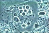 Entamoeba gingivalis