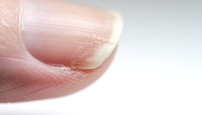 The sign on your nail that could be a cancer red flag & other symptoms to know