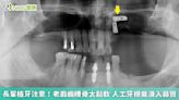 長輩植牙注意！老翁齒槽骨太鬆軟 人工牙根竟滑入鼻竇