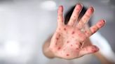 Descartan 'emergencia' en CDMX por sarampión; hay 7 casos confirmados
