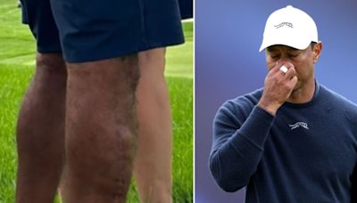 New photo of Tiger Woods' uncovered leg shows full extent of brutal surgery