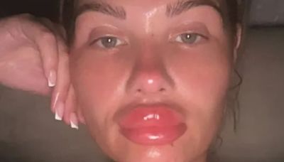 Love Island's Shaughna Phillips reveals shocking pic of huge swollen lips