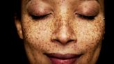 Health Conditions Your Dermatologist Can Detect Just From Looking At Your Skin