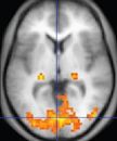 Functional magnetic resonance imaging