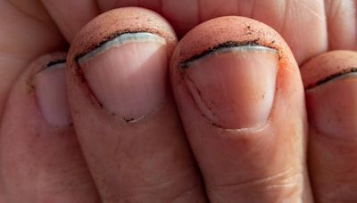 Seeing This 1 Colour Under Your Fingernails Could Reveal Health Issues