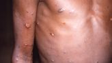 Monkeypox transmission ‘occurs up to four days before symptoms appear’