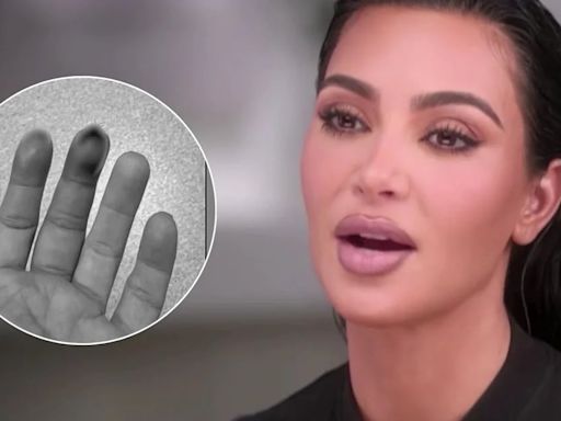Kim Kardashian sufrió una fractura en su mano tras golpearse con una puerta: “Parecía que el hueso sobresalía”