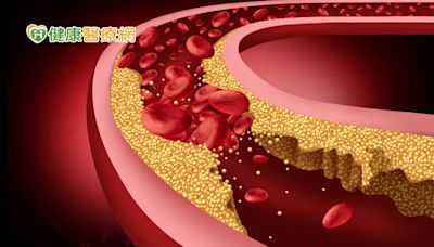 新研究：膽固醇太高竟會失智? 降到1數字可降低失智風險