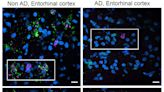 Study across multiple brain regions discerns Alzheimer's vulnerability and resilience factors