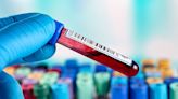 Blood test 91% accurate at predicting Alzheimer's, outperforming doctors