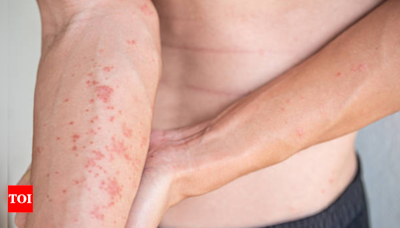 Scratching beyond the surface: Here’s all you need to know about Atopic Dermatitis - Times of India