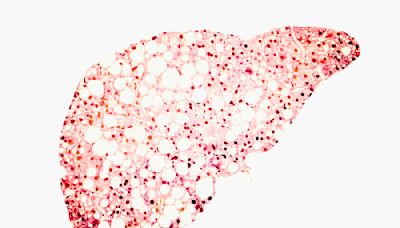 Diabetes and obesity can damage the liver to the point of failure – but few people know their risk of developing liver disease