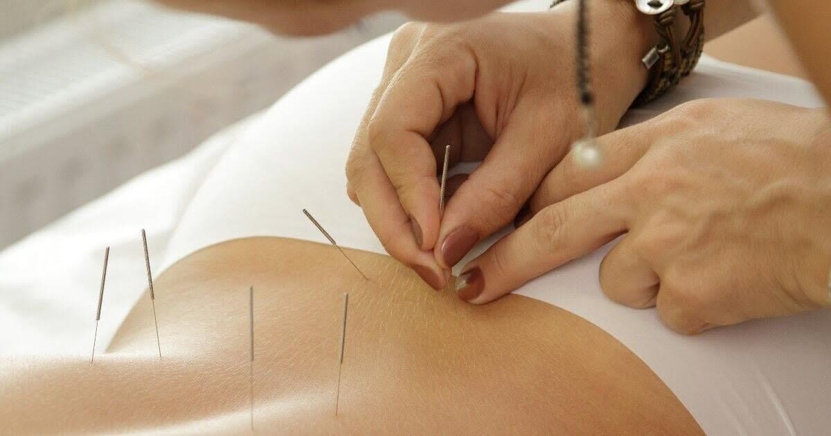 Acupuncture Can Ease Side Effects of Breast Cancer Treatment