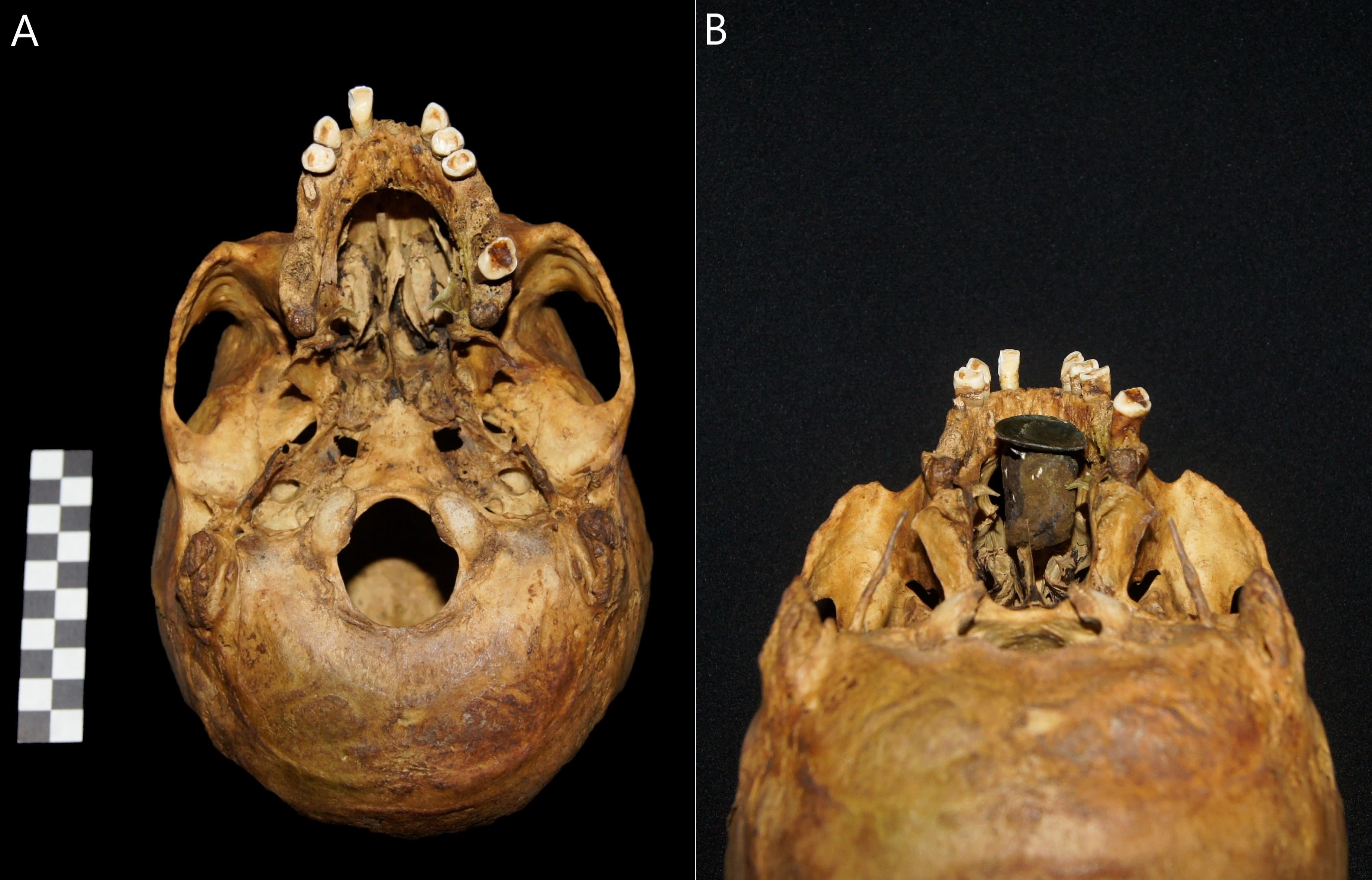 Archaeologists discover "unique" artificial body part in 18th century skull