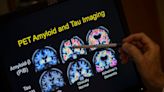 Data from MRI can predict who will get Alzheimer’s and when, researchers say