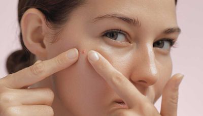 Voici les gestes à adopter pour se débarrasser d'un bouton sur le visage, selon une dermatologue
