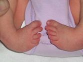 Clubfoot