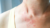 These Pictures Will Help You Identify the Most Common Skin Rashes