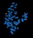 Chronic myelogenous leukemia