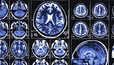 Alzheimer's: AI tool 3 times more accurate at predicting progression