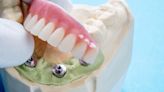 With U Dental Enhances Oral Health With Dental Implant Solutions in Melbourne
