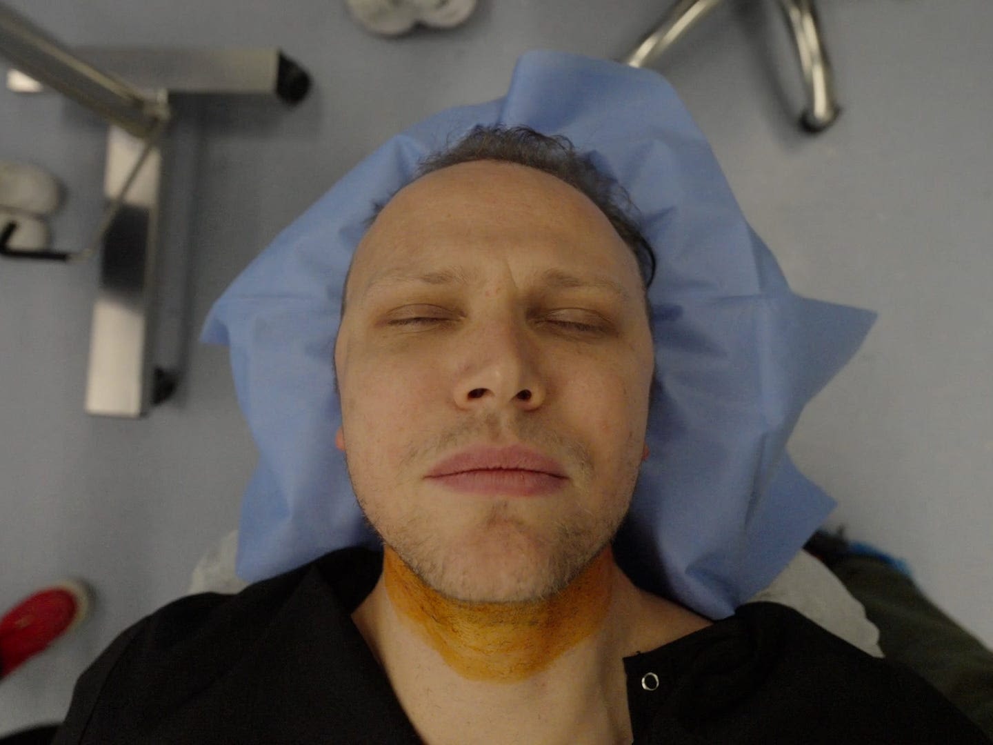 I got a hair transplant in Istanbul, a sanctuary for balding men. It pulled me out of a dark place.